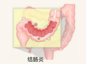 泉州到哪里治疗结肠炎好