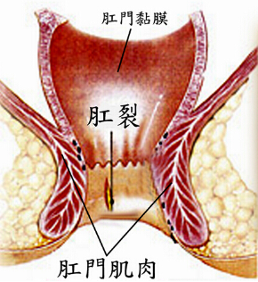 泉州治疗肛裂的手术方法？