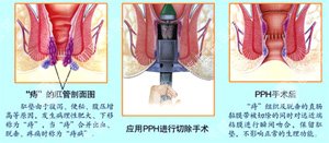 痔疮的较佳治疗方法吃什么药