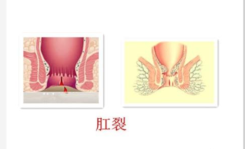 泉州得了肛裂怎么治疗好